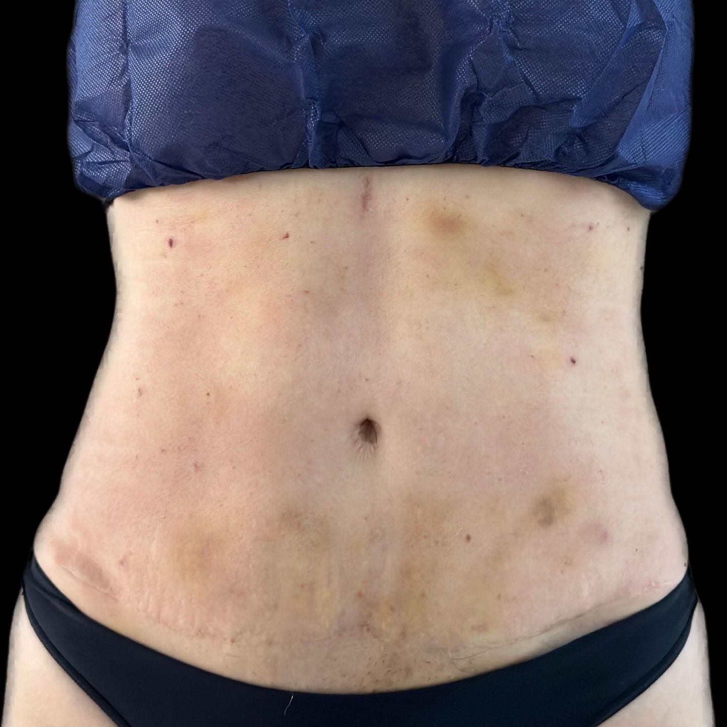 Before and after Endolift abdomen CDMX