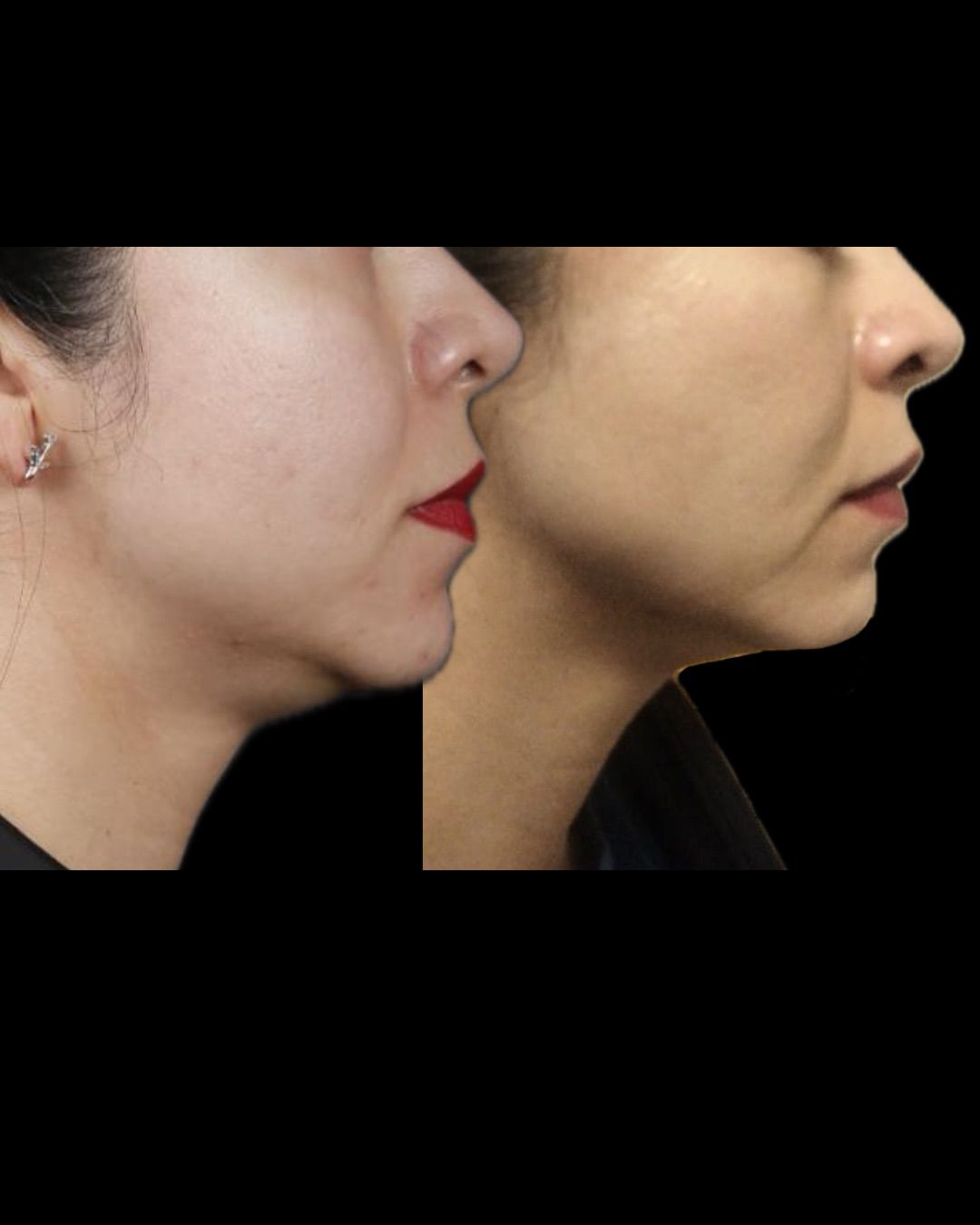 Before and after Endolift facial CDMX