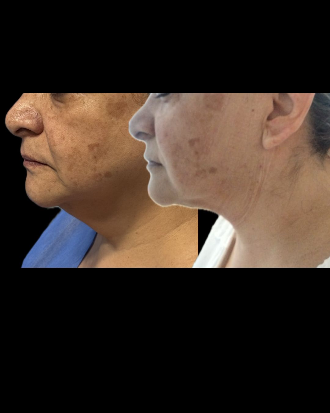Before and after Endolift en CDMX