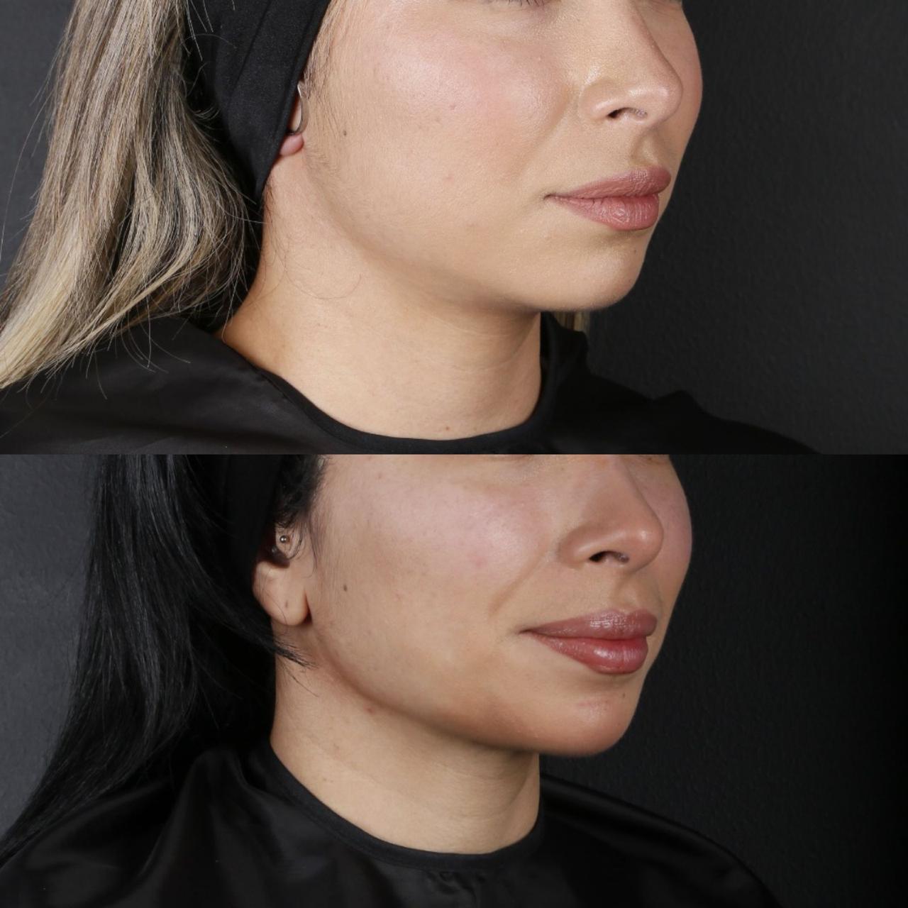 Before and after tratamiento Endolift abdomen en CDMX