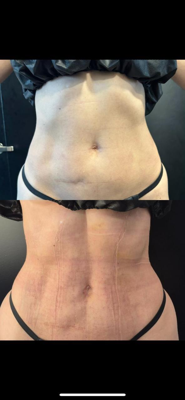 Before and after Endolift facial Polanco